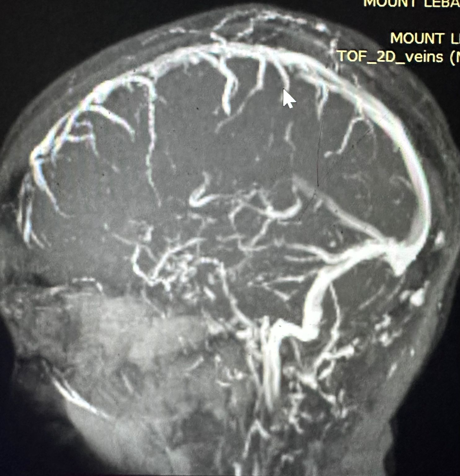 Meningioma Surgery
