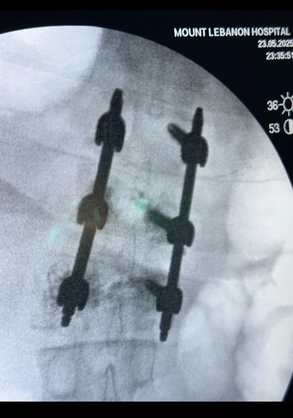 Percutaneous Screws Surgery